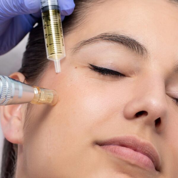 Renova skin + Dermaplaning